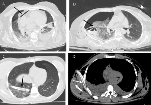 The Role Of Early Postmortem Ct In The Evaluation Of Support-line 