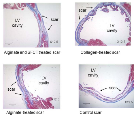 Postmortem morphometric analysis of sections from infarcted hearts