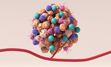 MDSCs in cancer