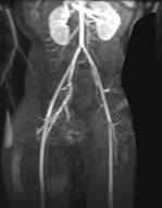 MR angiography of the vascular supply of a lymphangioma using 3D reconstructions