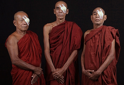 monks after surgery each with one eye covered